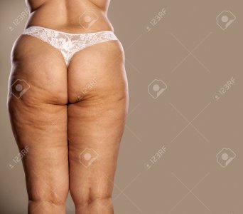 65622314-fat-female-with-cellulite-and-stretch-marks-in-white-thong.jpg
